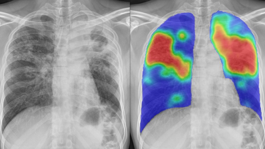 Utilisation de l'IA pour faciliter le diagnostic de la tuberculose à Batangafo, en République centrafricaine