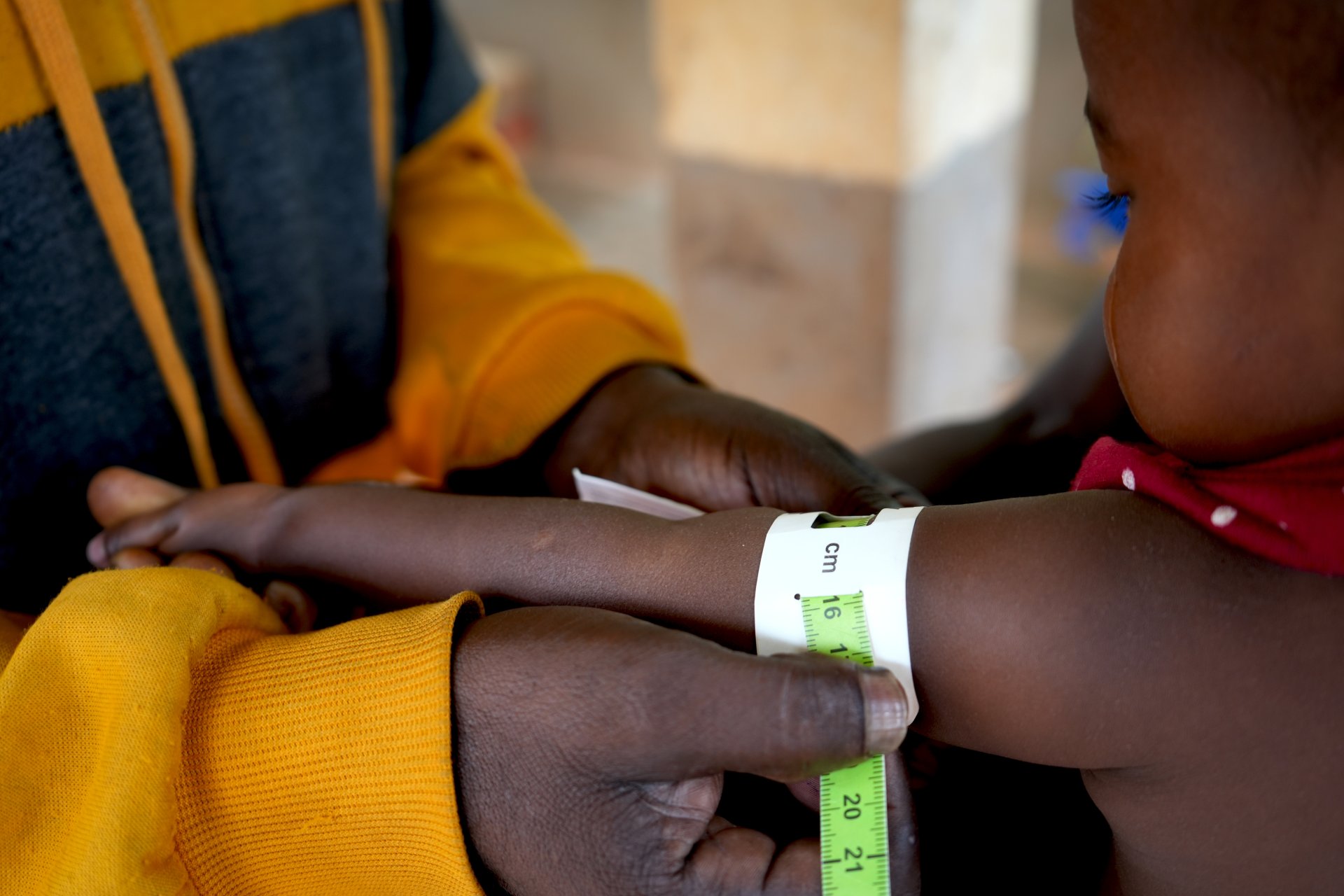 Un enfant subit un dépistage de la malnutrition dans une clinique soutenue par MSF dans le sud-est de Madagascar, une région sévèrement touchée par les cyclones Batsirai et Emnati en 2022. Ces catastrophes ont aggravé la situation nutritionnelle déjà précaire, avec des milliers d'enfants souffrant de malnutrition. 18/06/2024 