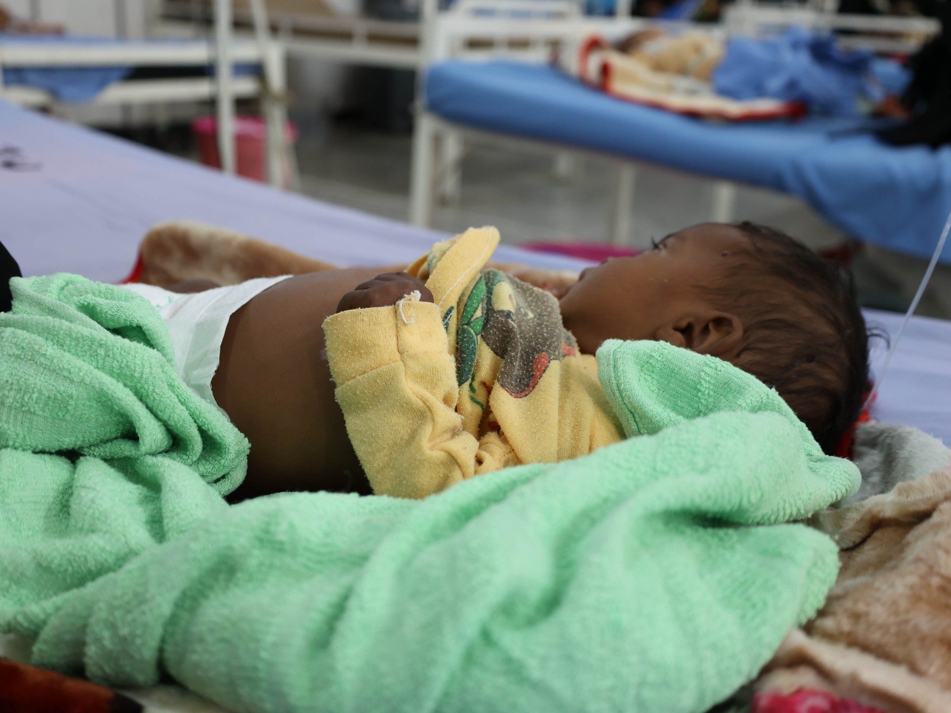 Un enfant de 6 mois est traité pour malnutrition aiguë modérée dans l'hôpital Abs, au Yemen.