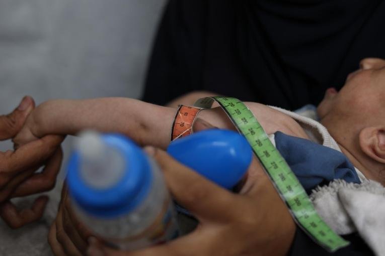 Un enfant palestinien souffrant de malnutrition passe un examen médical dans une clinique MSF à Gaza. © Nour Alsaqqa/MSF