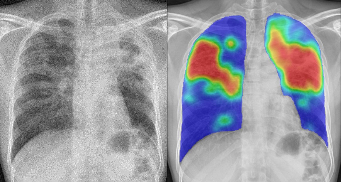 Utilisation de l'IA pour faciliter le diagnostic de la tuberculose à Batangafo, en République centrafricaine