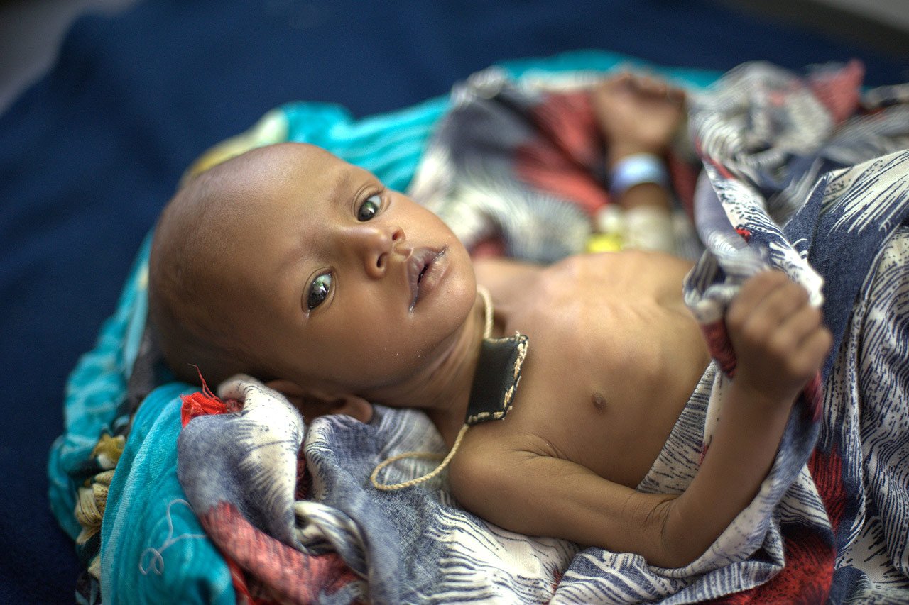 La malnutrition – une maladie qui peut être prévenue et soignée - touche 195 millions d'enfants dans le monde entier.