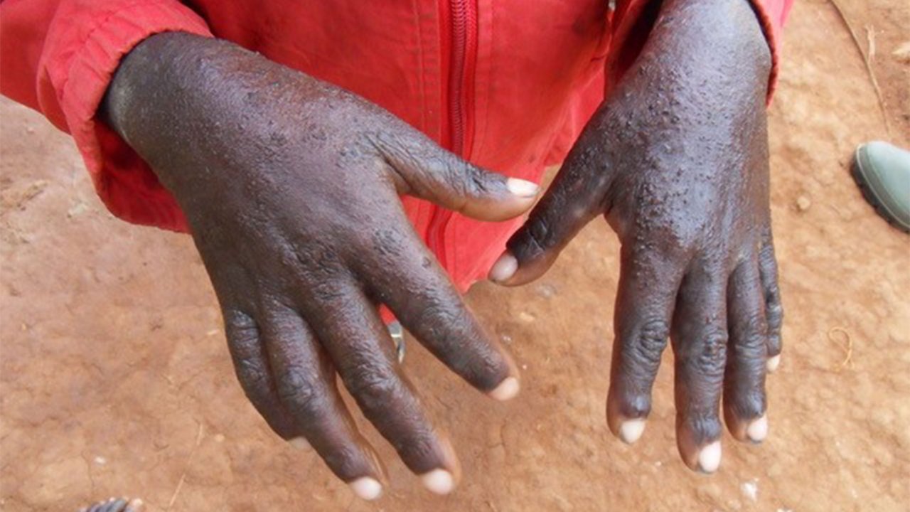 Les mains de Mandro, souffrant de la gale, en RDC.