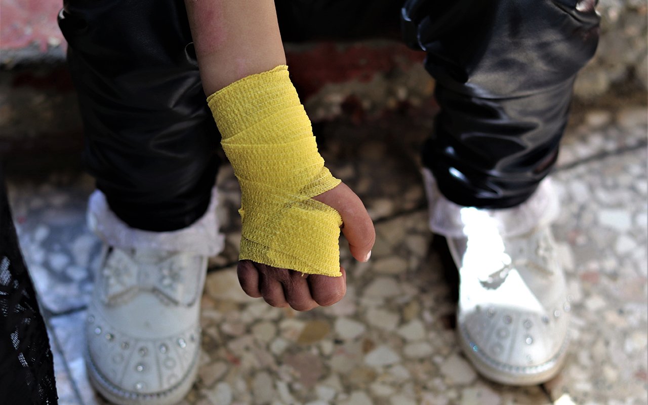 Jana, 2 ans et demi, reçoit un traitement dans la clinique de traumatologie et de brûlures de MSF à Gaza. Le 16 mai 2021, les frappes aériennes israéliennes dans la région ont endommagé la clinique, où MSF recoit chaque année plus de 1000 enfants en consultation. Gaza, 22 juin 2021.