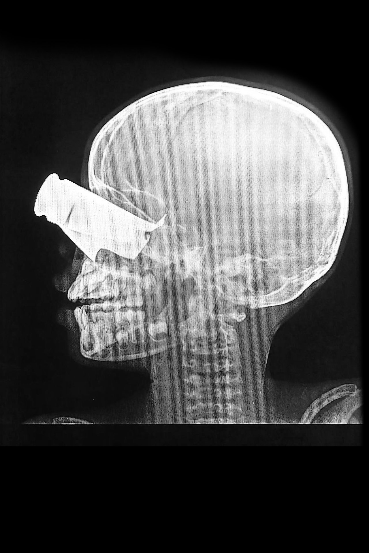 En février, un garçon de neuf ans est arrivé à l'hôpital soutenu par MSF à Tine, au Tchad, à la suite d'une attaque de drone dans l'ouest du Soudan. Il présentait une large blessure à l'œil causée par un éclat d'obus, de graves fractures au visage et deux doigts amputés. 